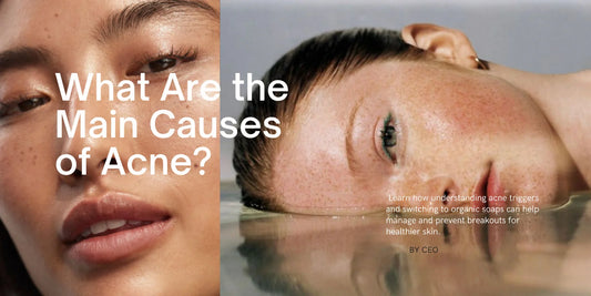 What Are the Main Causes of Acne?